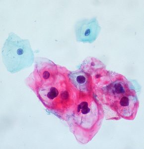 Tumori Papillomavirus